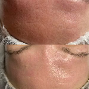 Nach einer Behandlung